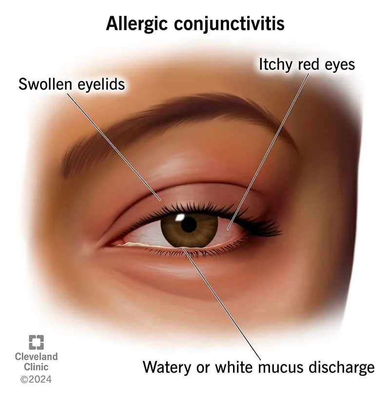 Is Your Eye Makeup Causing Infections? (Ophthalmologist Explains) 2 Allergic Conjunctivitis Symptoms