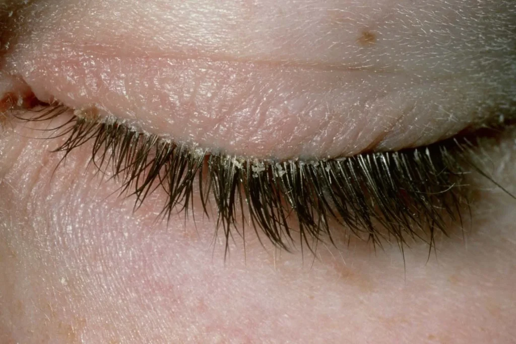 Is Your Eye Makeup Causing Infections? (Ophthalmologist Explains) 3 Blepharitis Inflammation of the Eyelid Margins