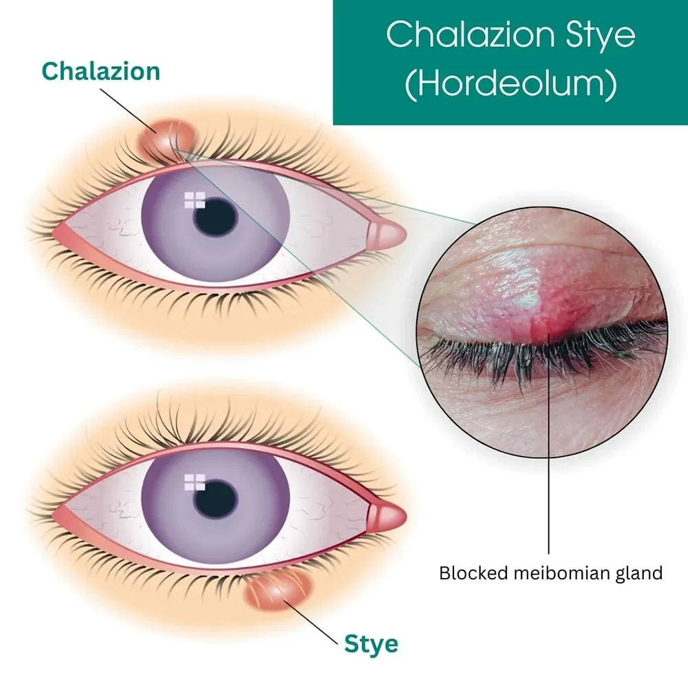 Is Your Eye Makeup Causing Infections? (Ophthalmologist Explains) 4 Chalazion vs Stye Blocked Meibomian Gland