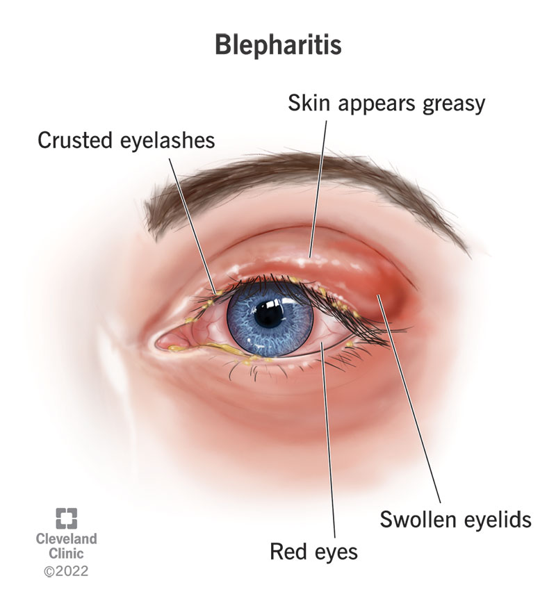 Digital Eye Strain? Eye Specialist in Wakad Shares Screen-Safe Habits 5 Blepharitis Explained Symptoms of Eyelid Inflammation