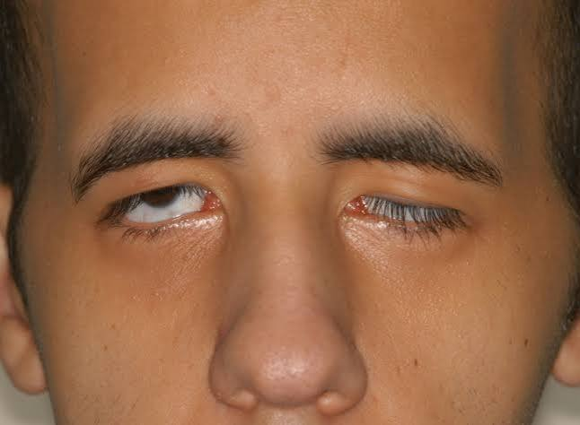 Digital Eye Strain? Eye Specialist in Wakad Shares Screen-Safe Habits 2 Eye Strain Ocular Fatigue Due to Screen Overuse