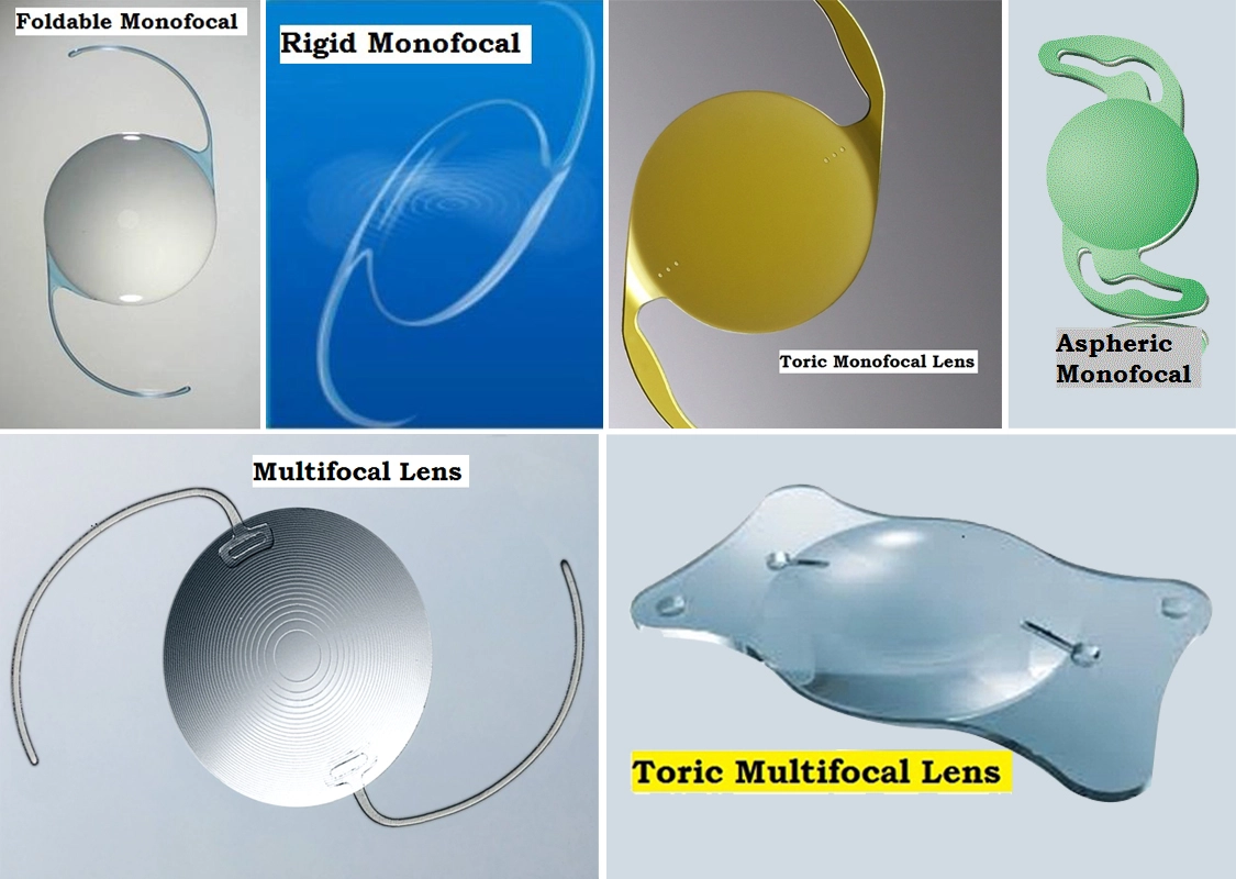 Why Cataract Surgery Is Simple, Lens Choice Isn’t 2 image1